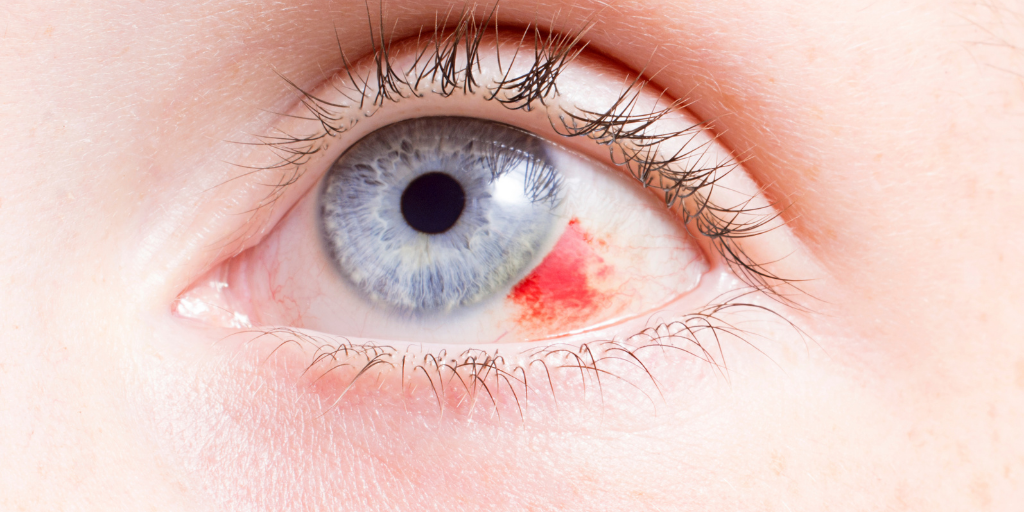 Eye Emergencies for the Non-Ophthalmologist