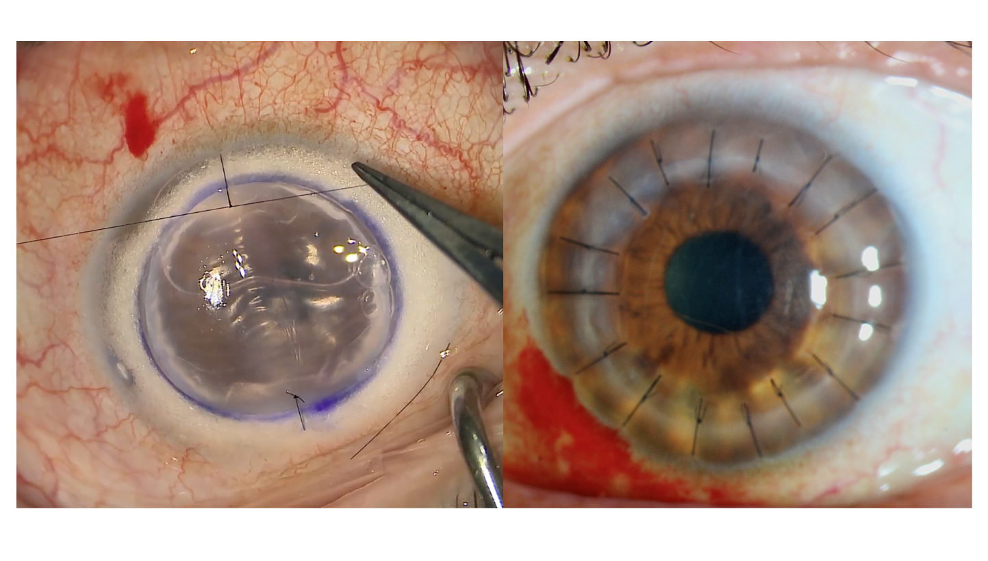 Moorfields corneal suturing and penetrating keratoplasty wet lab