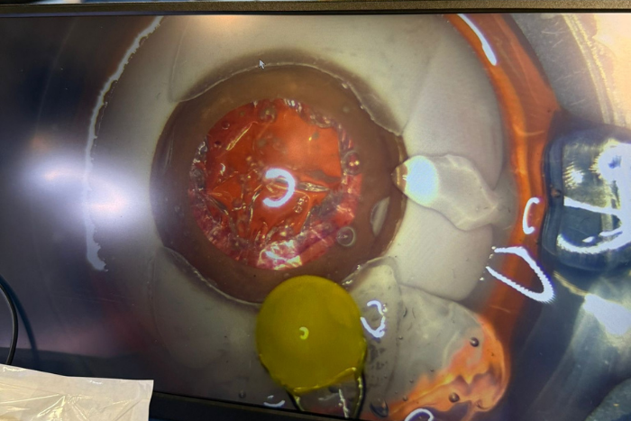 Moorfields Manual Small Incision Cataract Surgery (MSICS)