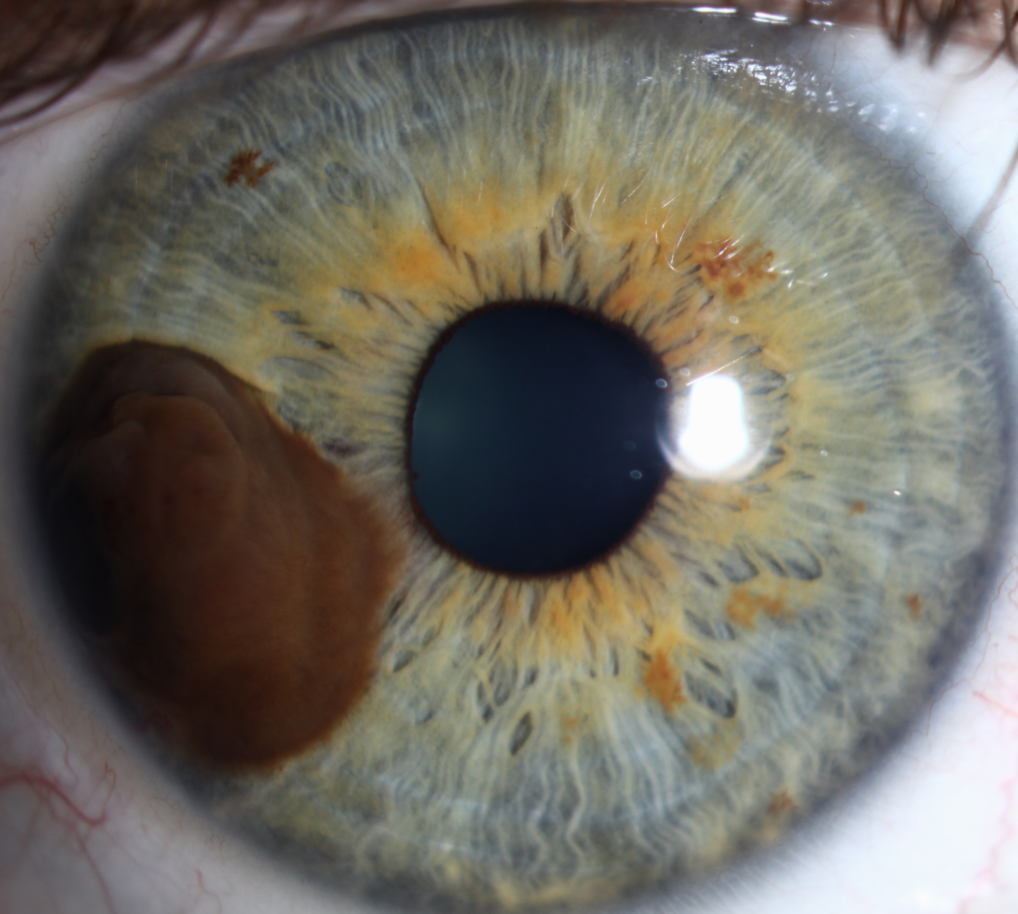 Ocular oncology for the non-ocular oncologist: what you need to know for clinical practice